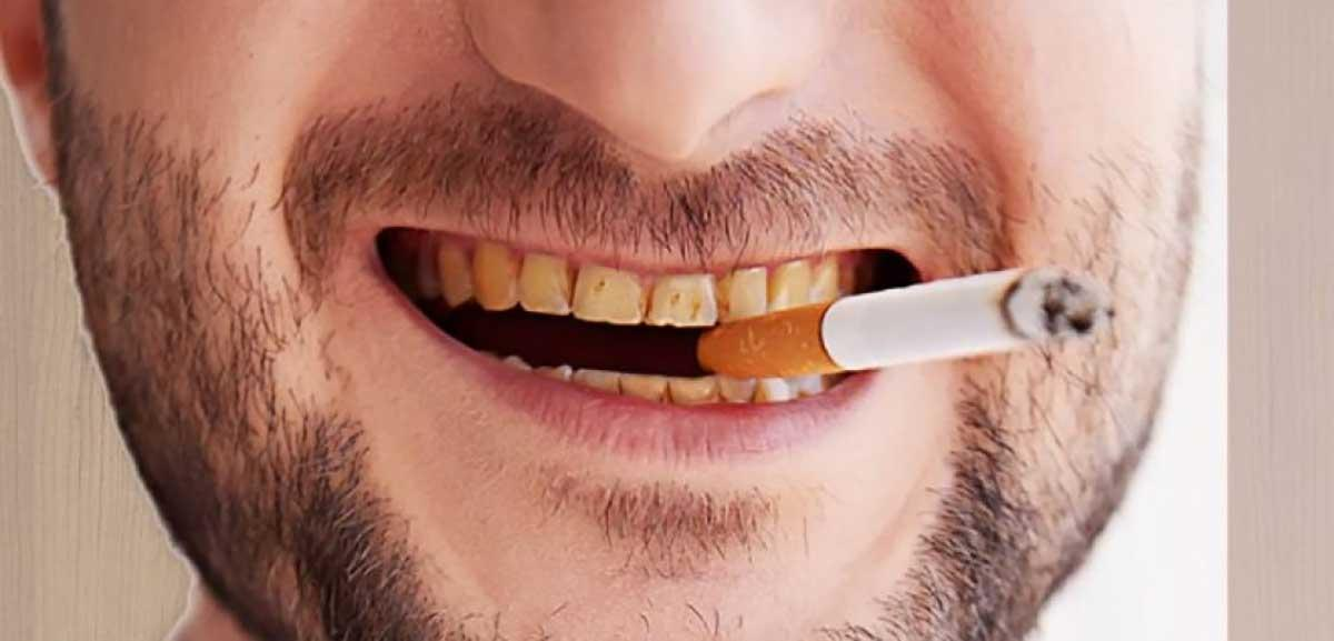 Hút thuốc lá gây vàng răng, hôi miệng